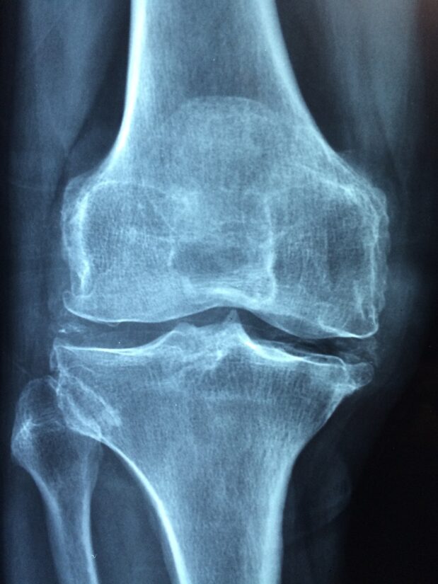 Knee View In X-Ray